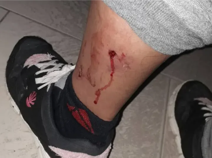 PERRO, MORDEDURA